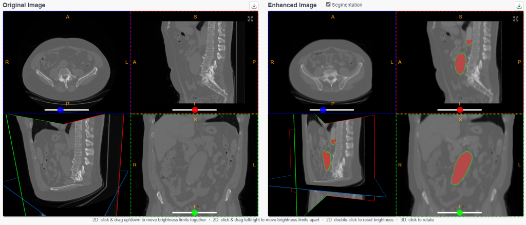 AiSentia: digital contrast added to CT scans using AI