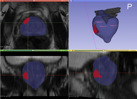 Lucida Medical Receives CE Marking For Pi, Its AI-machine Learning ...