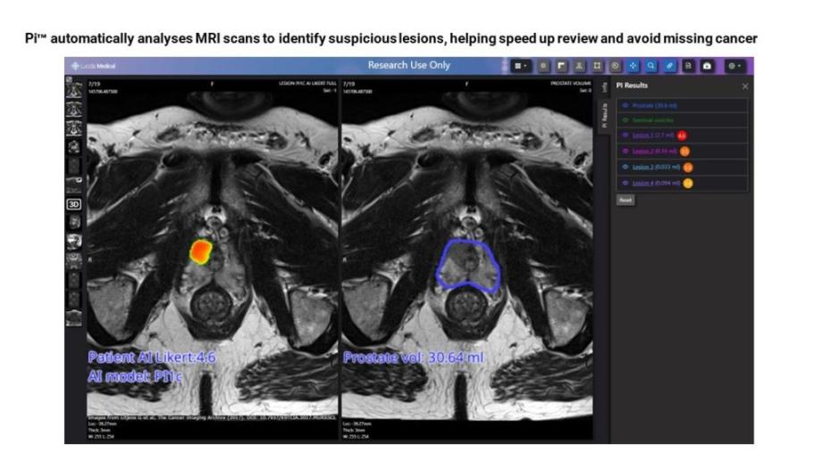 AI technology to help diagnose prostate cancer