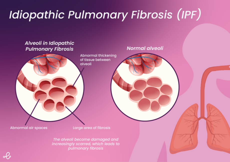 idiopathic pulmonary fibrosis